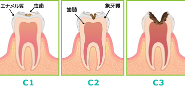 なぜ虫歯は黒い？