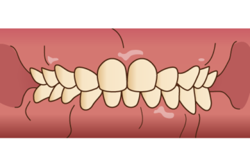 子供の歯並びディープバイト