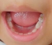 子供の歯石