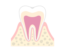 C0(エナメル質の損傷)