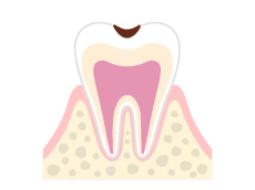 C1(象牙質の損傷)