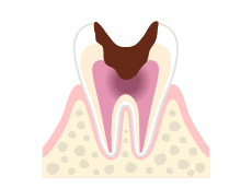 C3(歯髄の損傷)