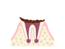 C4(歯の完全な損傷)